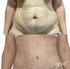 Abdominoplastika - GÉVÉ Klinika