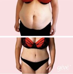 Abdominoplastika - GÉVÉ Klinika