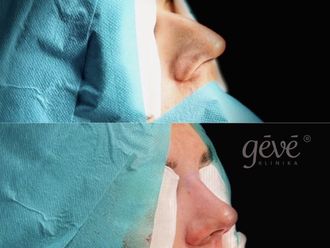 Rhinoplastika - 848403