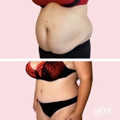 Abdominoplastika - GÉVÉ Klinika