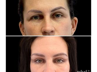 Blefaroplastika pred a po - 868591
