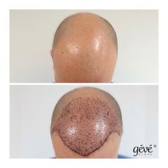 Transplantácia vlasov - GÉVÉ Klinika