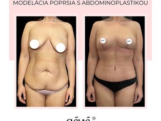Abdominoplastika - 868603