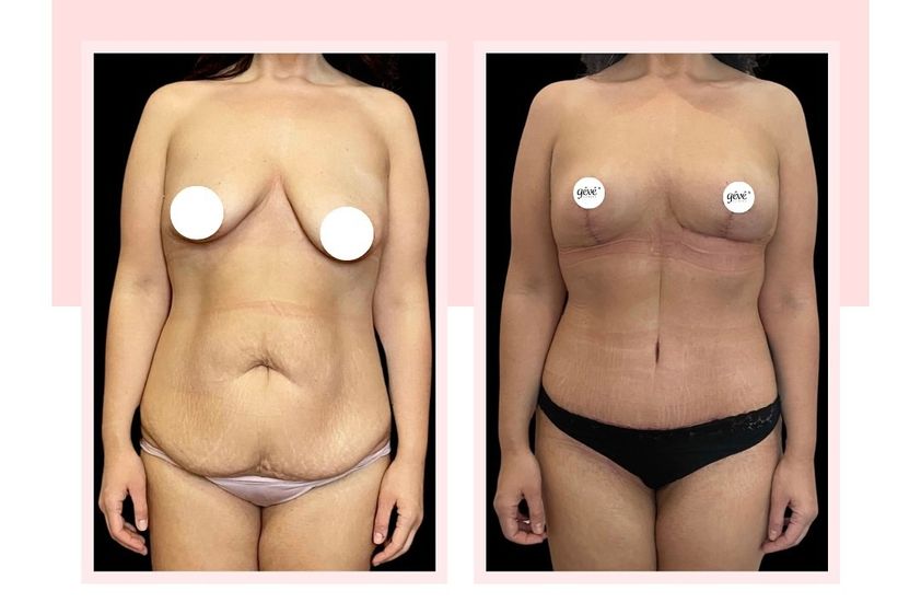 Abdominoplastika pred a po - 868603
