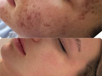 Odstránenie jaziev laserom pred a po - 876844