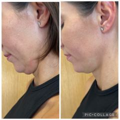 MUDr. Hajnalka Méryová Faragó - Redukcia dvojitej brady