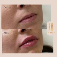 MUDr. Hajnalka Méryová Faragó - Augmentácia pier