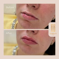 Augmentácia pier - MUDr. Hajnalka Méryová Faragó