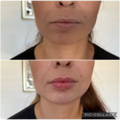 Augmentácia pier - MUDr. Hajnalka Méryová Faragó