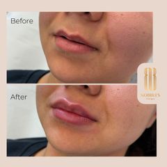 Augmentácia pier - MUDr. Hajnalka Méryová Faragó