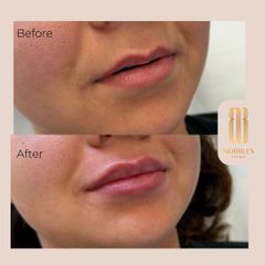 Augmentácia pier - MUDr. Hajnalka Méryová Faragó