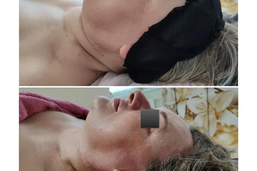 Mezoterapia pred a po - 845102