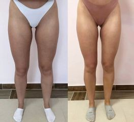 Neinvazívna liposukcia - Dream Beauty