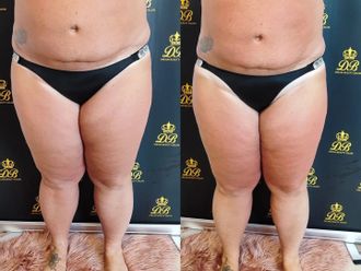 Neinvazívna liposukcia pred a po - 852661