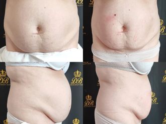 Neinvazívna liposukcia pred a po - 852662