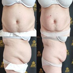 Neinvazívna liposukcia - Dream Beauty