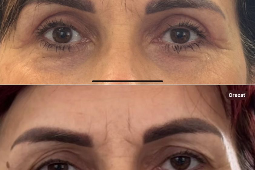 Blefaroplastika pred a po - 869841