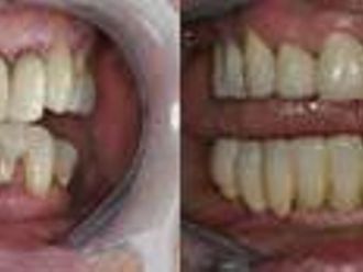 Zubné implantáty - 804036