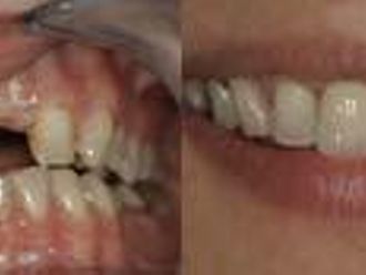 Zubné implantáty - 804037