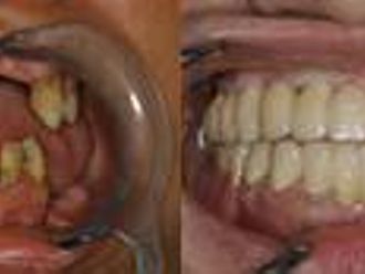 Zubné implantáty - 804040