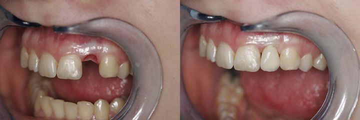 zubna korunka 1