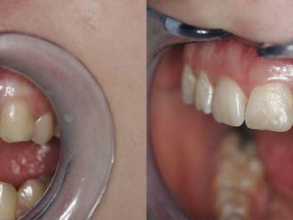 Zubné implantáty - 804045