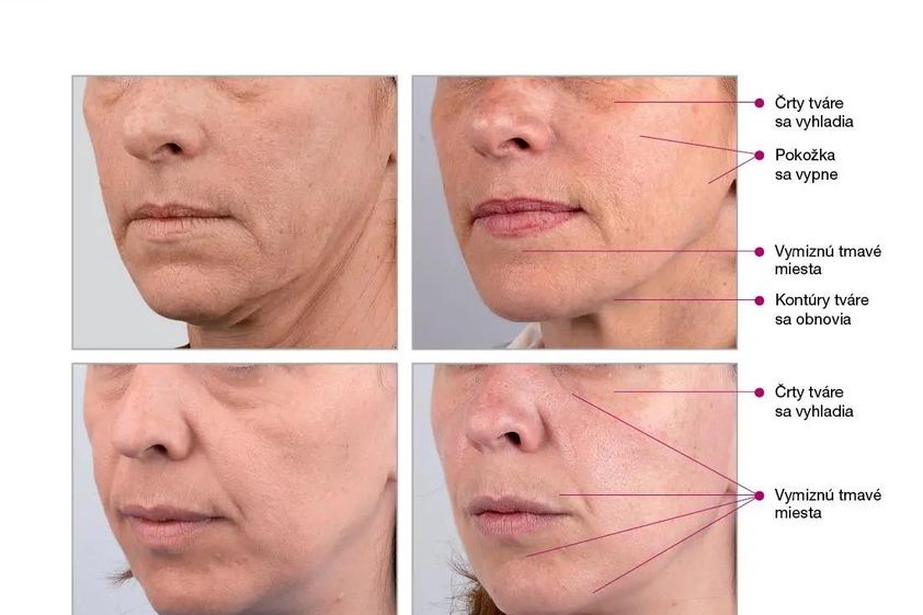 Mezoterapia pred a po - 805364