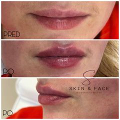 Zväčšenie pier - Skin & Face Dermaesthetic
