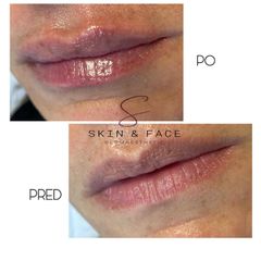 Zväčšenie pier - Skin & Face Dermaesthetic