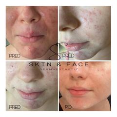 Liečba akné - Skin & Face Dermaesthetic