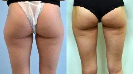 BEFORE lipo4