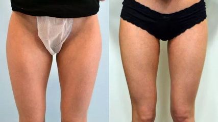 BEFORE lipo5