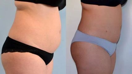 BEFORE lipo6