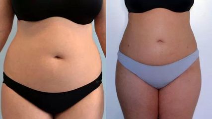 BEFORE lipo7