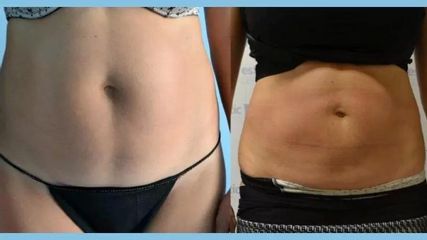 BEFORE lipo9