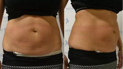 BEFORE lipo10