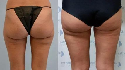 BEFORE lipo11