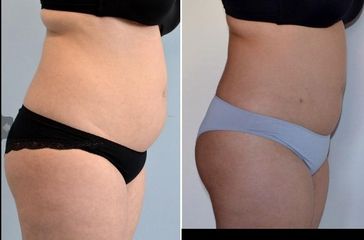 pred lipo