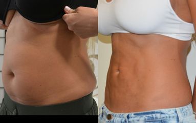 lipo2a