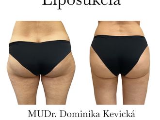 Liposukcia pred a po - 858559