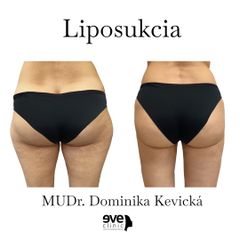 Liposukcia - Eveclinic Bratislava