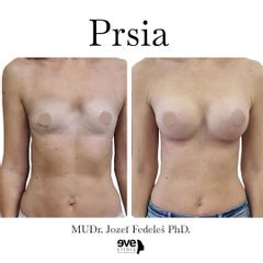 Zväčšenie pŕs - Eveclinic Bratislava