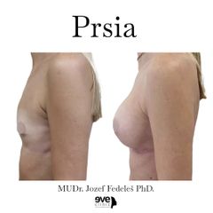 Zväčšenie pŕs - Eveclinic Bratislava