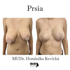 Zmenšenie prsníkov - Eveclinic Bratislava