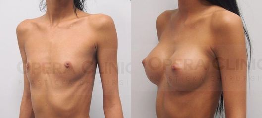 Augmentácia prsníkov, pod sval, implantát 300 ml okrúhly