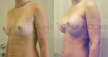 Augmentácia prsníkov, 360 cc okrúhle implantáty, uložené pod sval