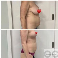 Abdominoplastika - MUDr. Juraj Paliatka