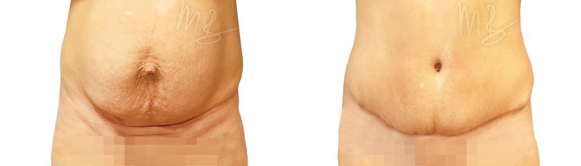 Abdominoplastika (Operácia brucha)