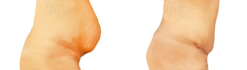 Abdominoplastika (Operácia brucha)