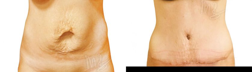 Abdominoplastika (Operácia brucha)